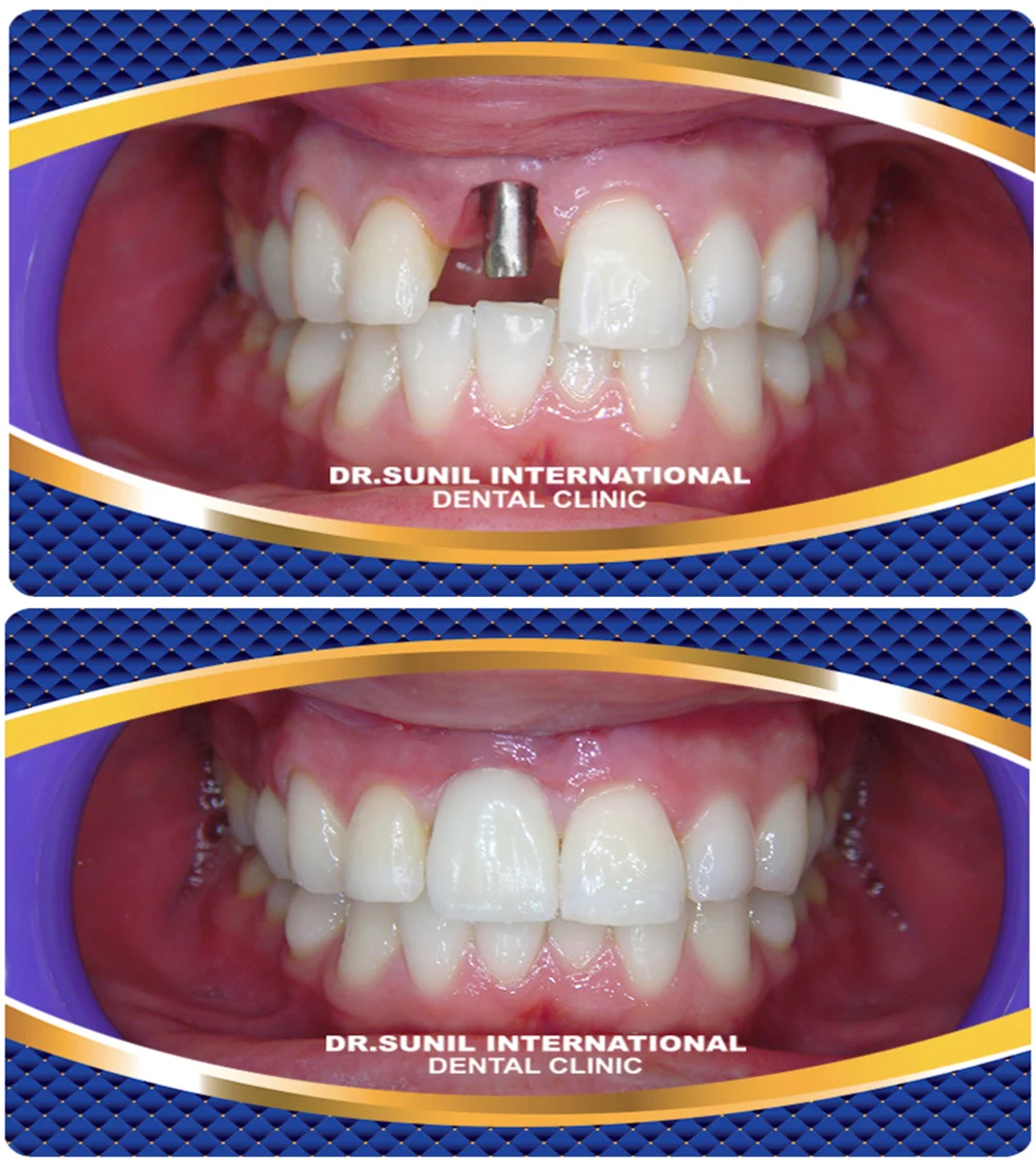 Teeth implants in bangkok